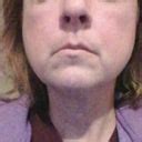 I am considering whether to have a lower face lift or Kybella .